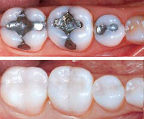 What is the Difference Between White Fillings and Silver Fillings - Resin