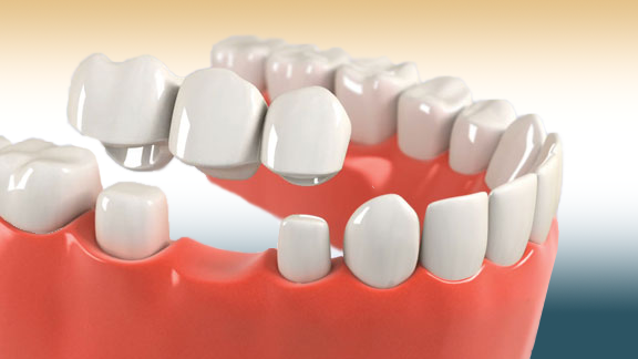 What are Dental Crowns and Bridges?