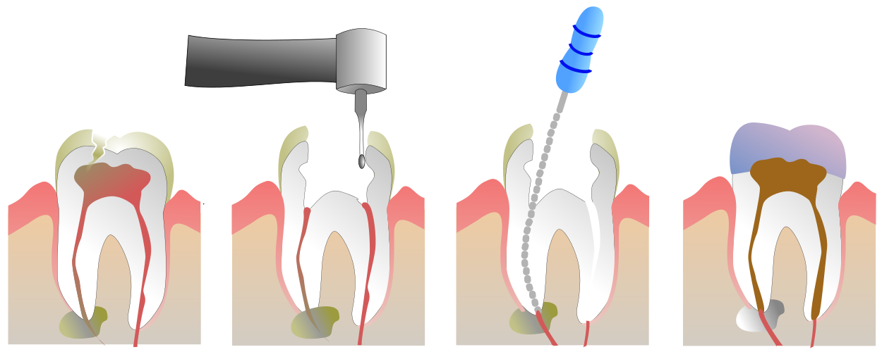 root canal kenosha, kenosha root canal, root canal dentist kenosha