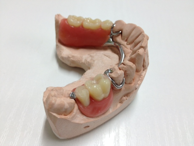 removable partial dentures