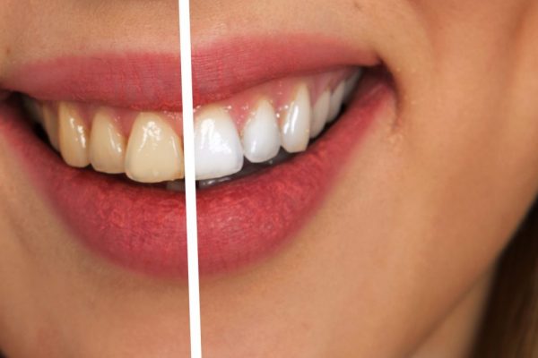 teeth whitening in kenosha, kenosha teeth whitening, teeth whitening