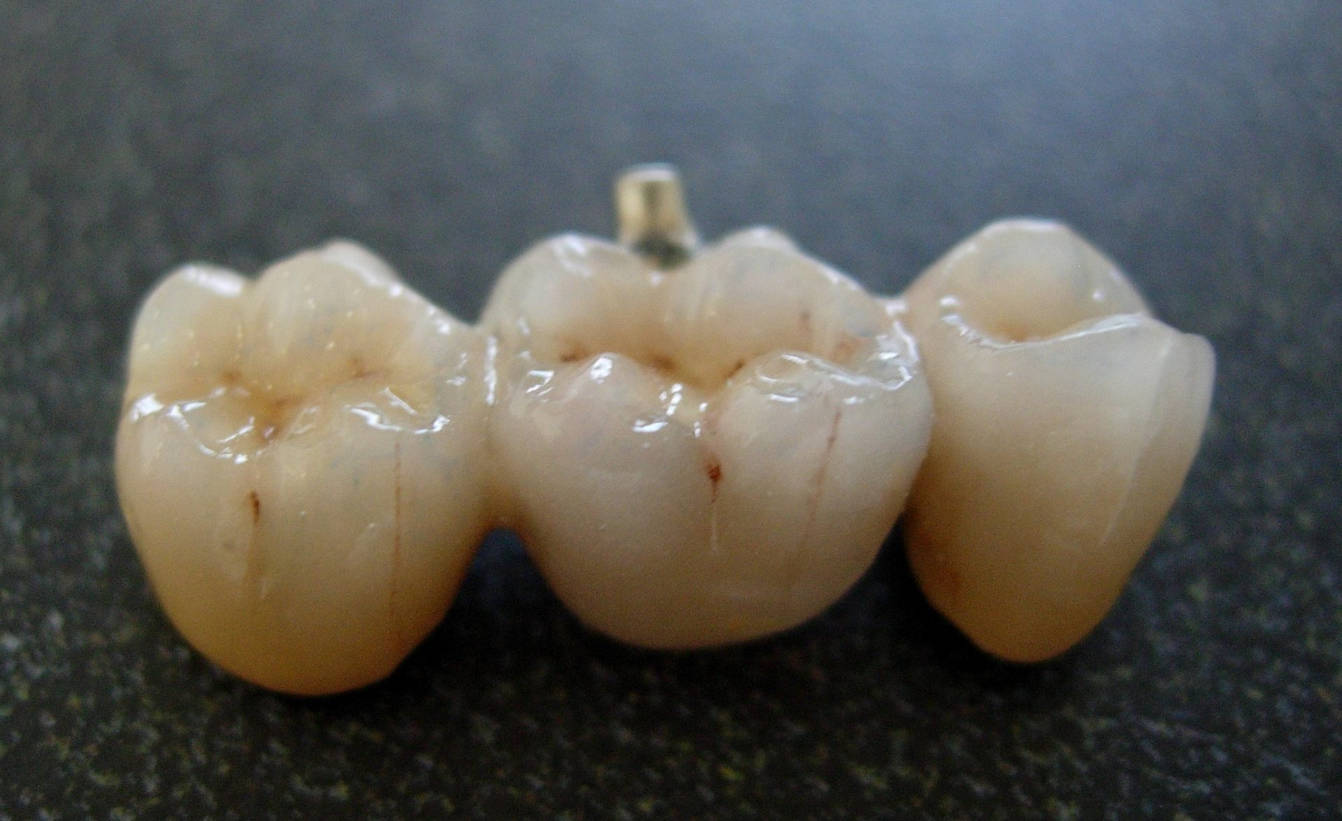 dental bridge options, dental bridges in kenosha, kenosha area family dentists