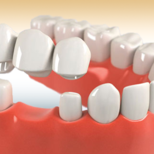 dental bridge in kenosha, bridge dental in kenosha, kenosha dental bridges